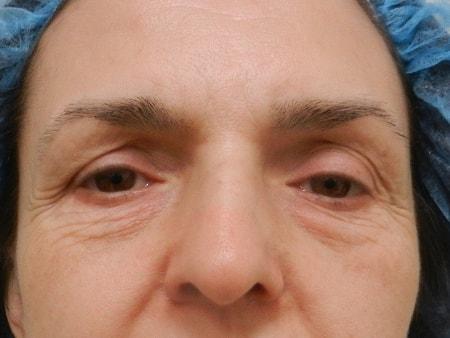 Brow Lift before at The Art of Plastic Surgery (Gregory A. Wiener, MD) in Chicago, IL