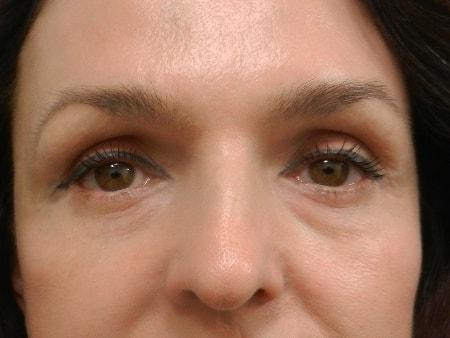Brow Lift after at The Art of Plastic Surgery (Gregory A. Wiener, MD) in Chicago, IL