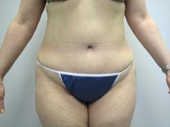 The Art of Plastic Surgery (Gregory A. Wiener, MD) tummy tuck after — Chicago, IL