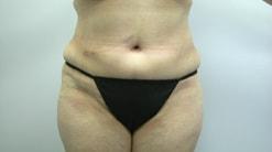 The Art of Plastic Surgery (Gregory A. Wiener, MD) tummy tuck after — Chicago, IL
