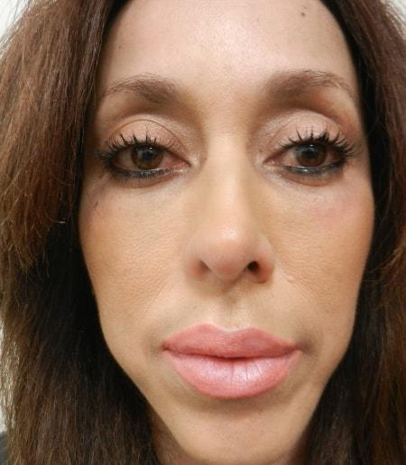 Fat Transfer after at The Art of Plastic Surgery (Gregory A. Wiener, MD) in Chicago, IL