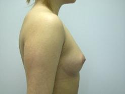 Breast Augmentation before at The Art of Plastic Surgery (Gregory A. Wiener, MD) in Chicago, IL