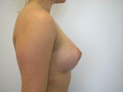 Breast Augmentation after at The Art of Plastic Surgery (Gregory A. Wiener, MD) in Chicago, IL