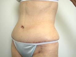 The Art of Plastic Surgery (Gregory A. Wiener, MD) tummy tuck after — Chicago, IL