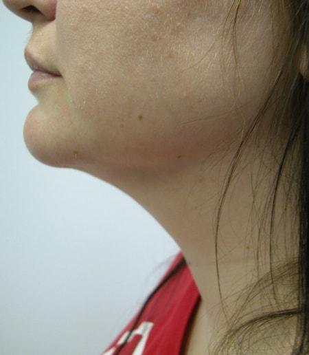 Neck Liposuction after at The Art of Plastic Surgery (Gregory A. Wiener, MD) in Chicago, IL