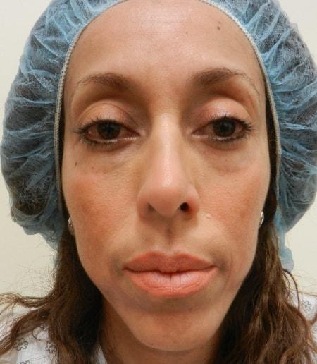 Fat Transfer before at The Art of Plastic Surgery (Gregory A. Wiener, MD) in Chicago, IL