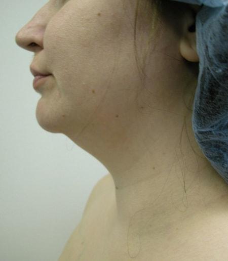 Neck Liposuction before at The Art of Plastic Surgery (Gregory A. Wiener, MD) in Chicago, IL