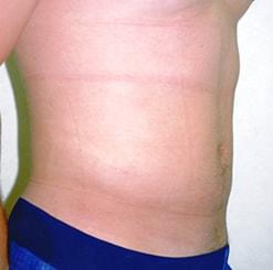 The Art of Plastic Surgery (Gregory A. Wiener, MD) liposuction after — Chicago, IL