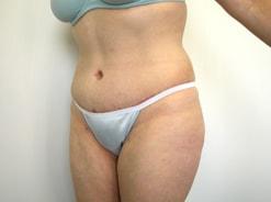 The Art of Plastic Surgery (Gregory A. Wiener, MD) tummy tuck after — Chicago, IL