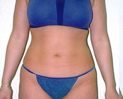 The Art of Plastic Surgery (Gregory A. Wiener, MD) liposuction after — Chicago, IL