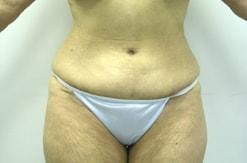 Tummy Tuck after at The Art of Plastic Surgery (Gregory A. Wiener, MD) in Chicago, IL