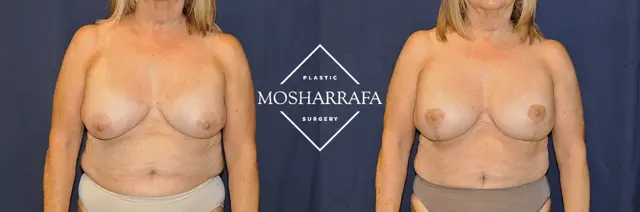 Breast Lift result at Tamir Mosharrafa, MD in Phoenix, AZ