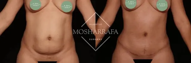 Mini Tummy Tuck result at Tamir Mosharrafa, MD in Phoenix, AZ