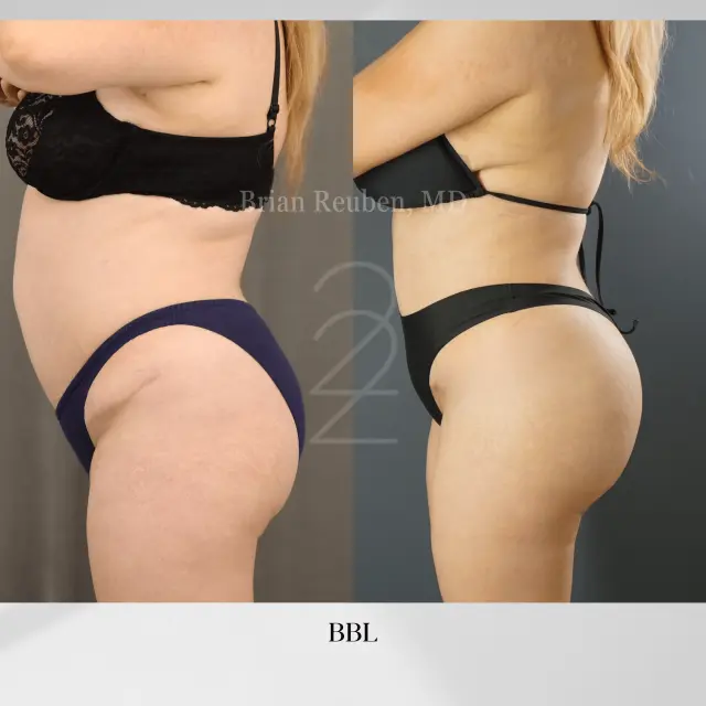 Brazilian Butt Lift result at 22 Plastic Surgery & Spa MD in Cottonwood Heights, UT
