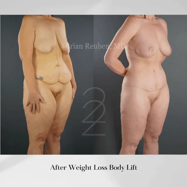 Thigh Lift result at 22 Plastic Surgery & Spa MD in Cottonwood Heights, UT