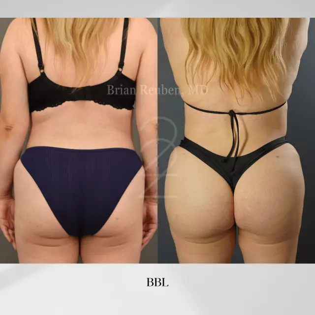 Brazilian Butt Lift result at 22 Plastic Surgery & Spa MD in Cottonwood Heights, UT