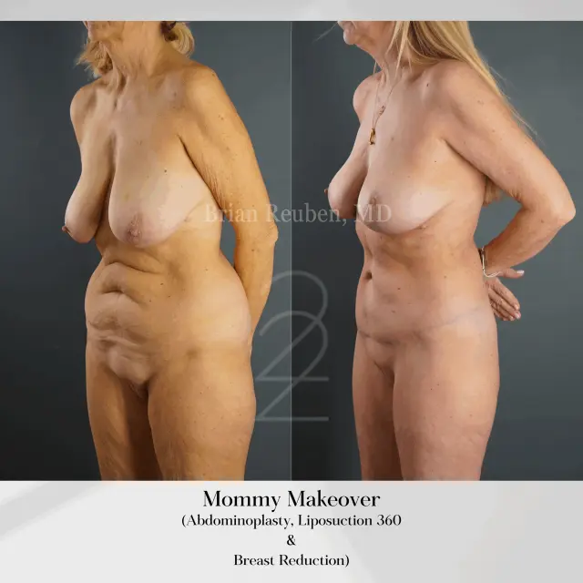 Mommy Makeover result at 22 Plastic Surgery & Spa MD in Cottonwood Heights, UT