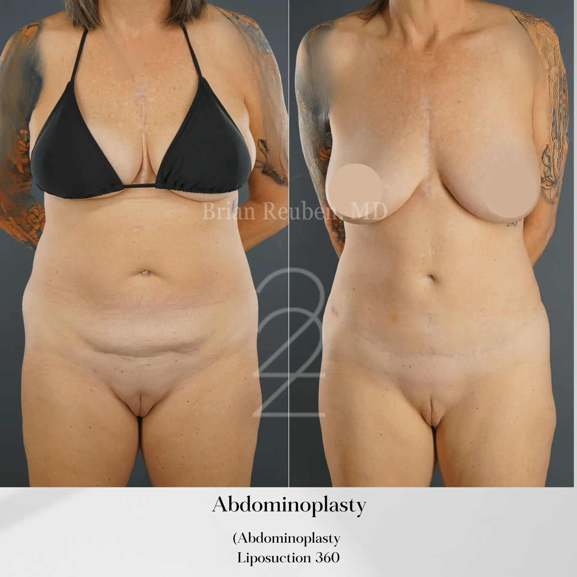 22 Plastic Surgery & Spa MD tummy tuck result — Cottonwood Heights, UT