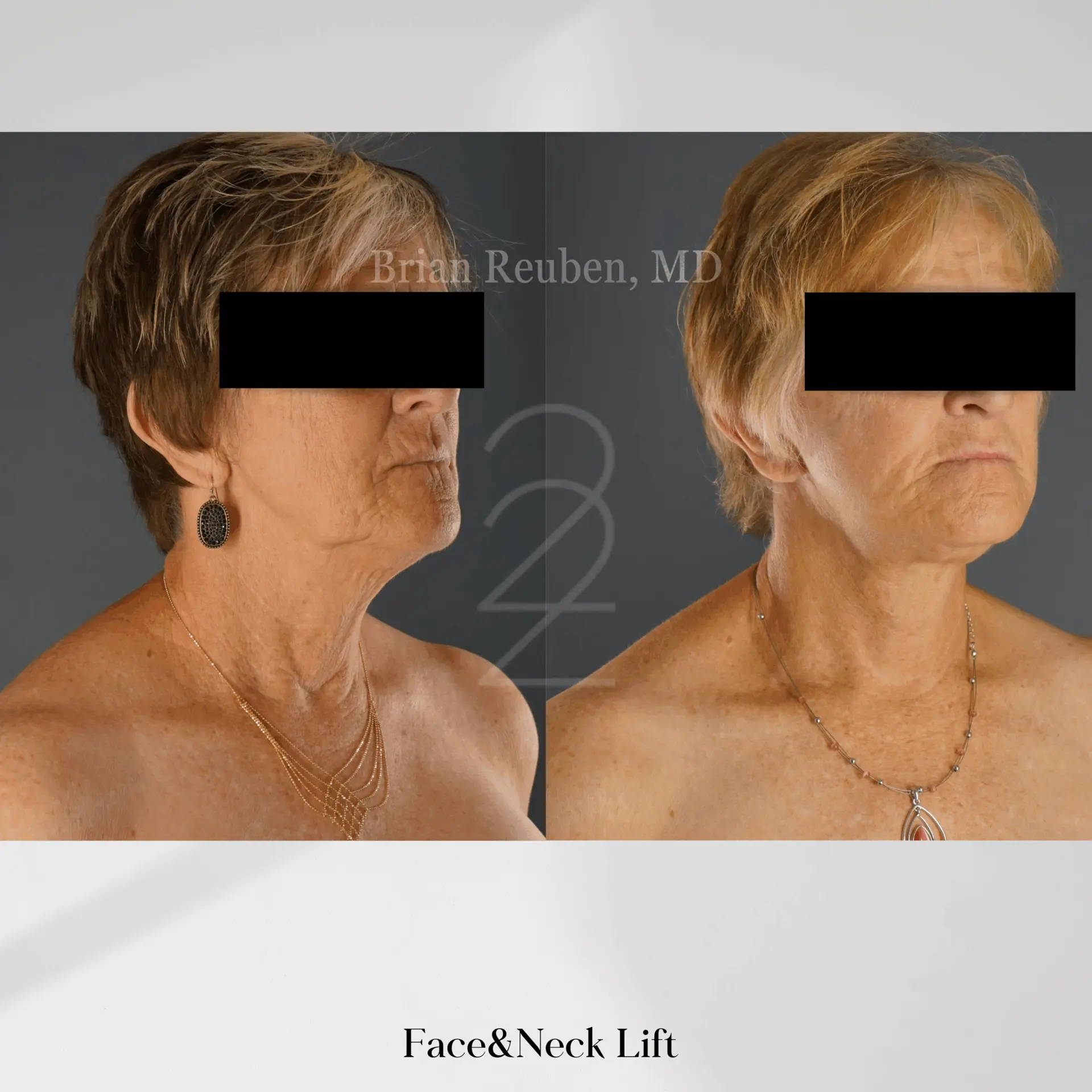 22 Plastic Surgery & Spa MD facelift result — Cottonwood Heights, UT