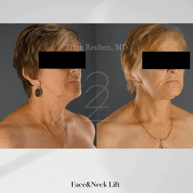 Facelift result at 22 Plastic Surgery & Spa MD in Cottonwood Heights, UT