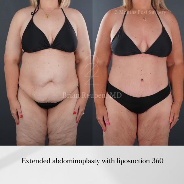 Tummy Tuck result at 22 Plastic Surgery & Spa MD in Cottonwood Heights, UT