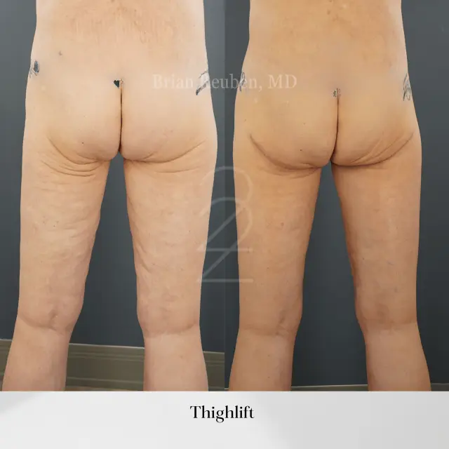 Thigh Lift result at 22 Plastic Surgery & Spa MD in Cottonwood Heights, UT
