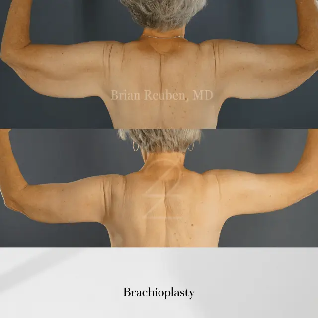 Arm Lift result at 22 Plastic Surgery & Spa MD in Cottonwood Heights, UT