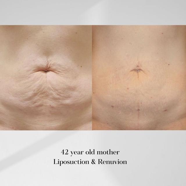 Morpheus8 result at 22 Plastic Surgery & Spa MD in Cottonwood Heights, UT