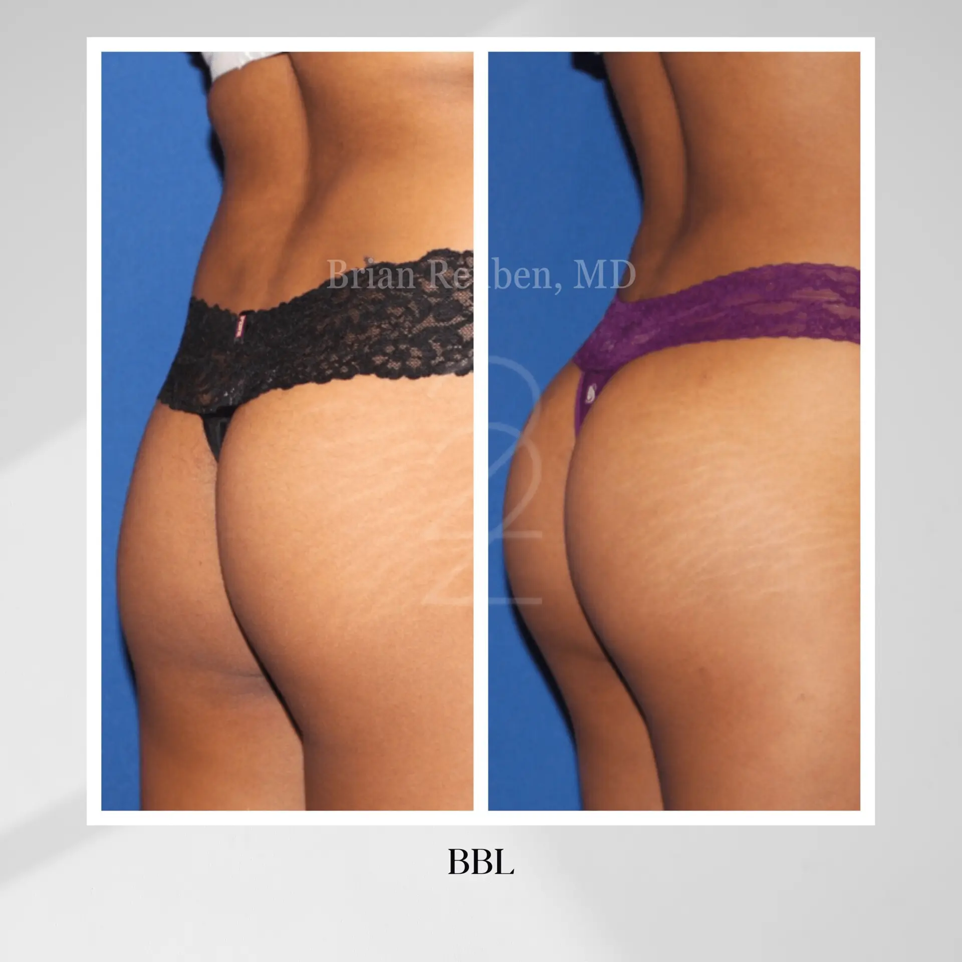 22 Plastic Surgery & Spa MD bbl result — Cottonwood Heights, UT