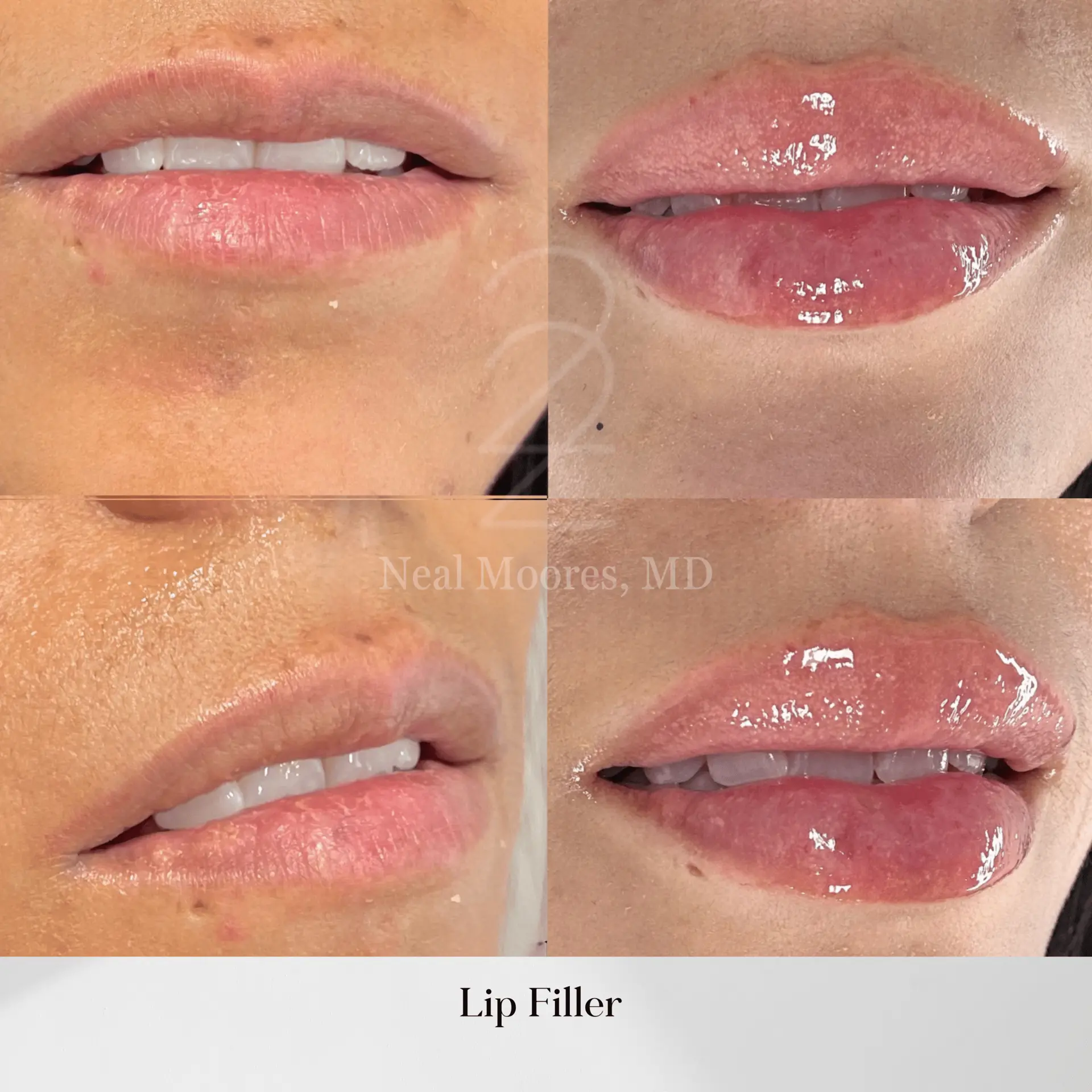 22 Plastic Surgery & Spa MD lip filler result — Cottonwood Heights, UT