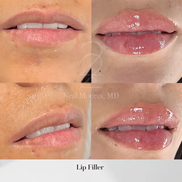 Lip Filler result at 22 Plastic Surgery & Spa MD in Cottonwood Heights, UT