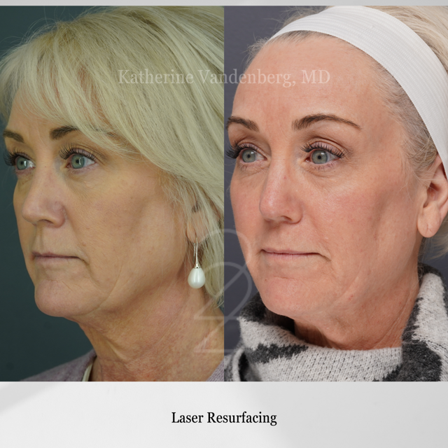 Laser Skin Resurfacing result at 22 Plastic Surgery & Spa MD in Cottonwood Heights, UT