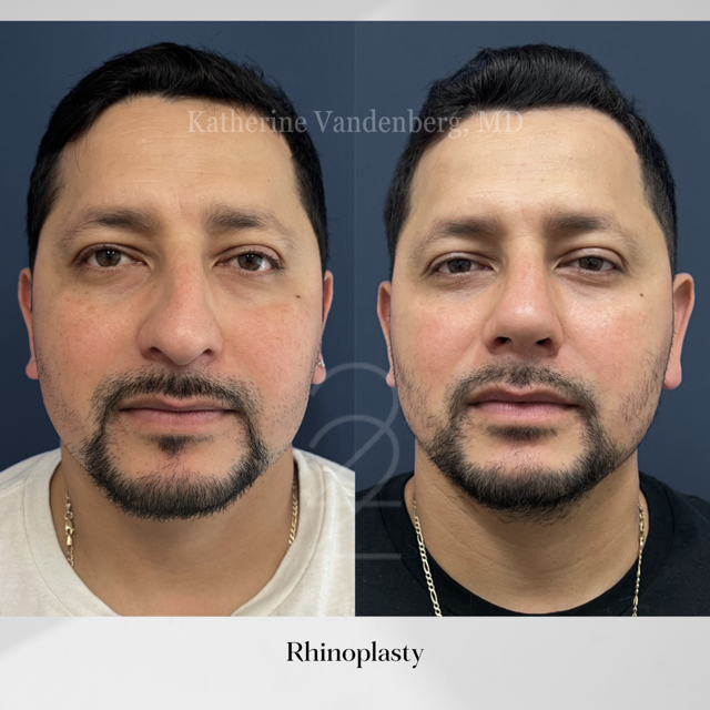 Rhinoplasty result at 22 Plastic Surgery & Spa MD in Cottonwood Heights, UT