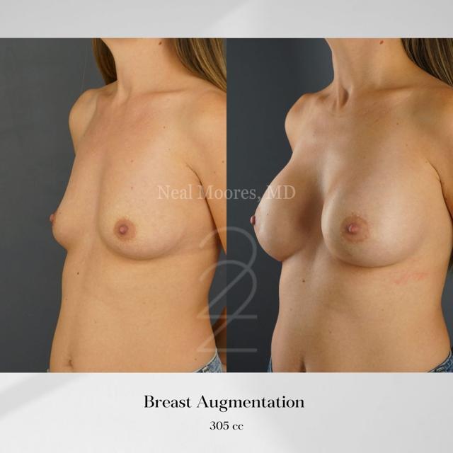 Breast Augmentation result at 22 Plastic Surgery & Spa MD in Cottonwood Heights, UT