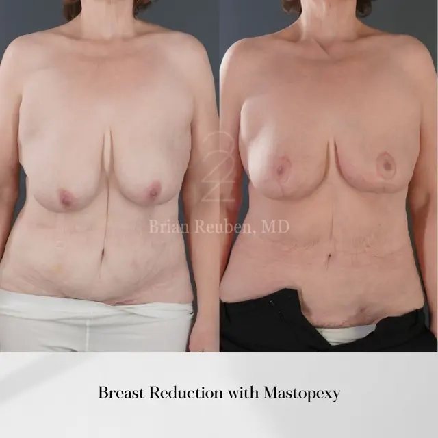 Breast Reduction result at 22 Plastic Surgery & Spa MD in Cottonwood Heights, UT