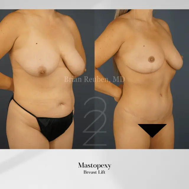 Breast Lift result at 22 Plastic Surgery & Spa MD in Cottonwood Heights, UT