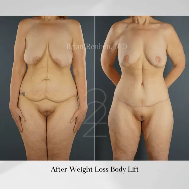 Thigh Lift result at 22 Plastic Surgery & Spa MD in Cottonwood Heights, UT