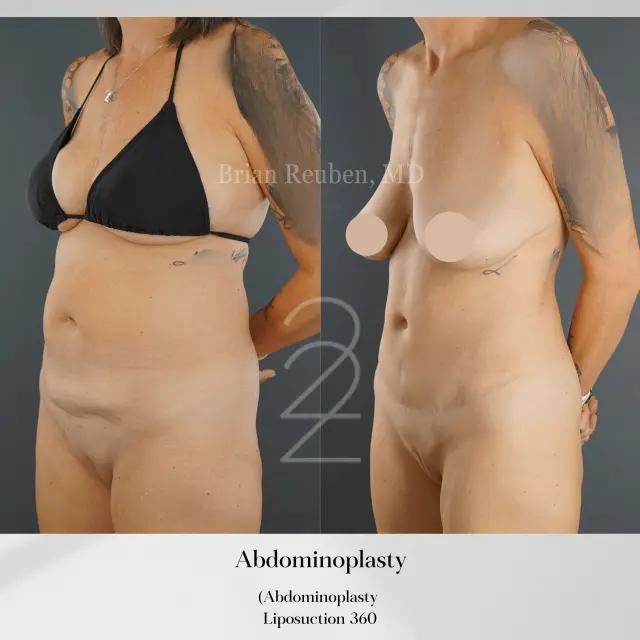 Tummy Tuck result at 22 Plastic Surgery & Spa MD in Cottonwood Heights, UT