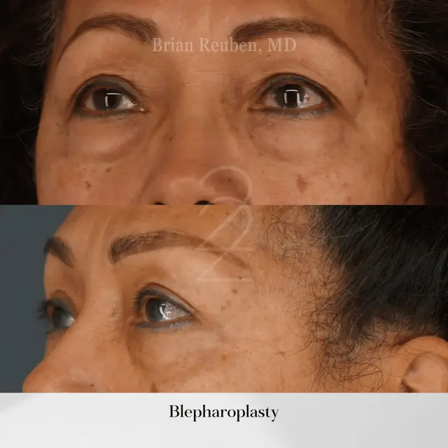 Blepharoplasty result at 22 Plastic Surgery & Spa MD in Cottonwood Heights, UT