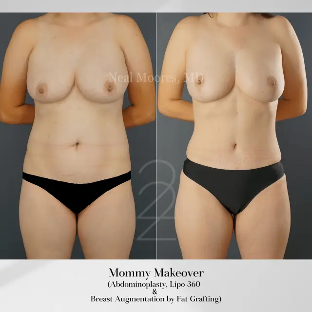 Mommy Makeover result at 22 Plastic Surgery & Spa MD in Cottonwood Heights, UT