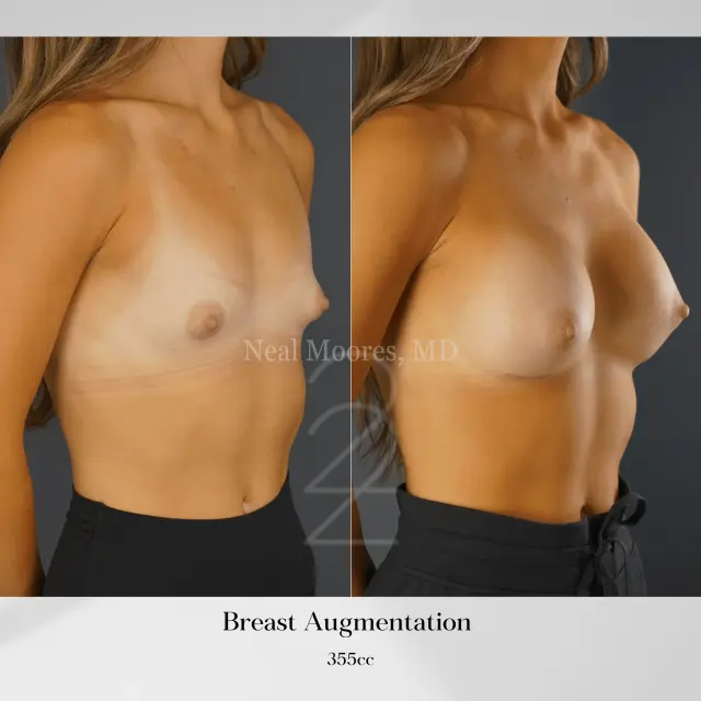 Breast Augmentation result at 22 Plastic Surgery & Spa MD in Cottonwood Heights, UT