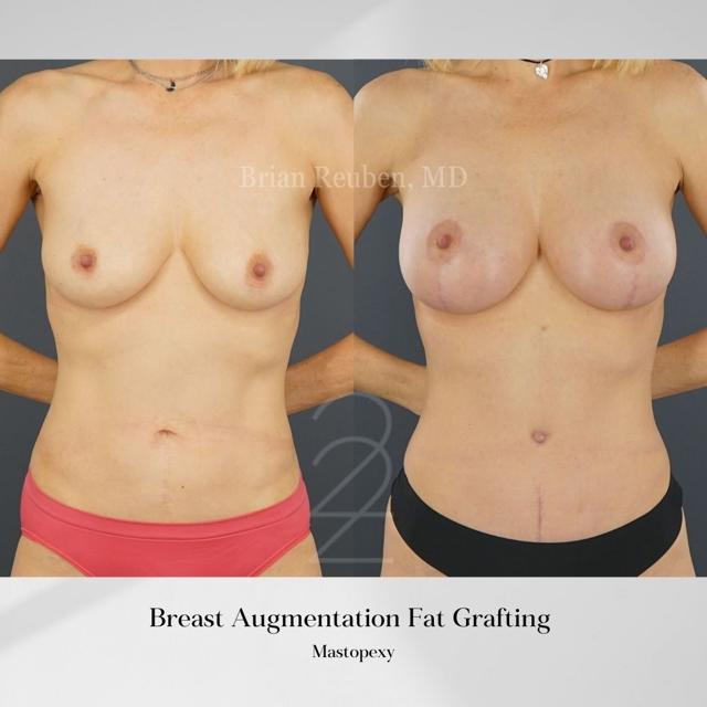Fat Transfer result at 22 Plastic Surgery & Spa MD in Cottonwood Heights, UT