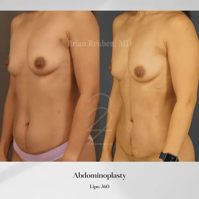 Tummy Tuck result at 22 Plastic Surgery & Spa MD in Cottonwood Heights, UT
