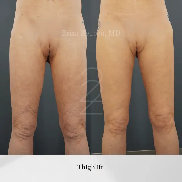Thigh Lift result at 22 Plastic Surgery & Spa MD in Cottonwood Heights, UT