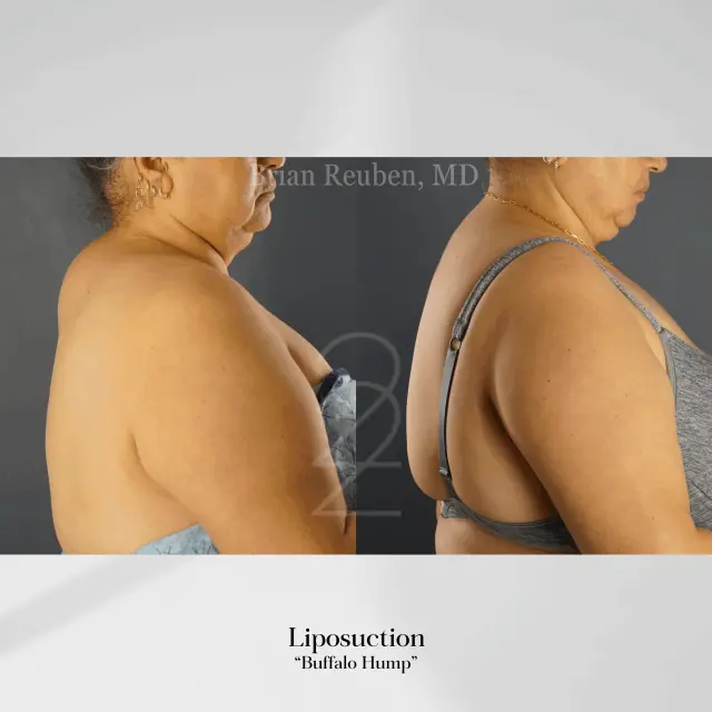 Liposuction result at 22 Plastic Surgery & Spa MD in Cottonwood Heights, UT