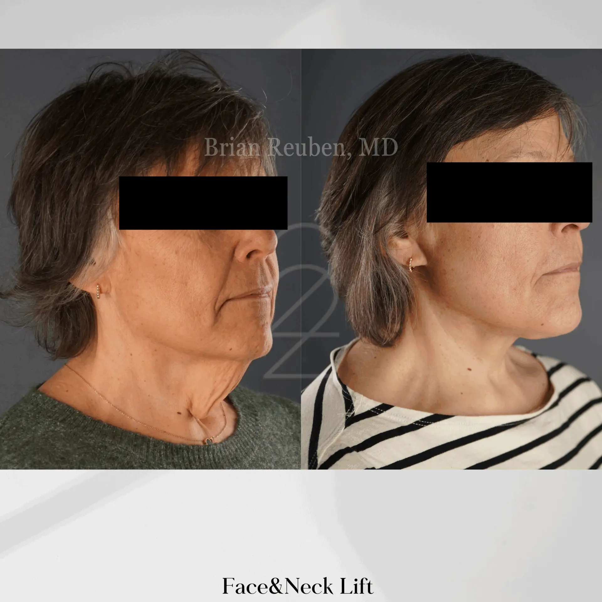 22 Plastic Surgery & Spa MD facelift result — Cottonwood Heights, UT