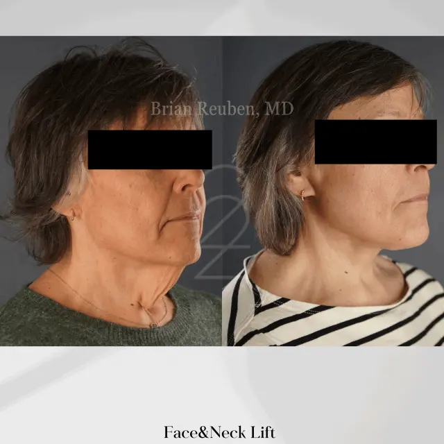 Facelift result at 22 Plastic Surgery & Spa MD in Cottonwood Heights, UT