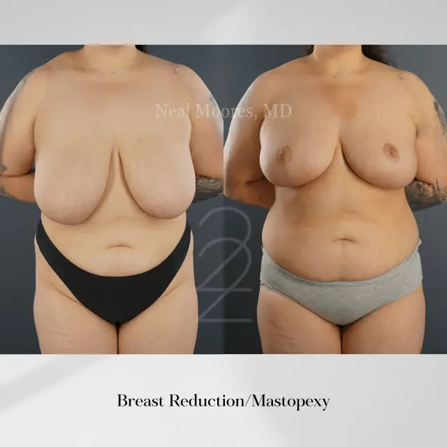 Breast Reduction result at 22 Plastic Surgery & Spa MD in Cottonwood Heights, UT