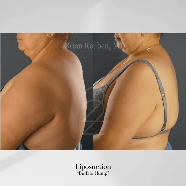 Liposuction result at 22 Plastic Surgery & Spa MD in Cottonwood Heights, UT