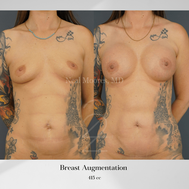 Breast Augmentation result at 22 Plastic Surgery & Spa MD in Cottonwood Heights, UT